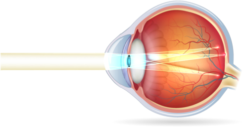 Astigmatisme-Ophtalmo-Paris-Est