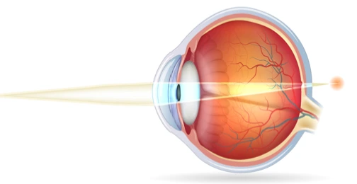 Hypermetropie - Ophtalmo Paris Est