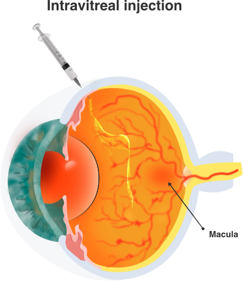 IVT-Votre ophtalmologue à St-Maur-des-Fossés & Draveil