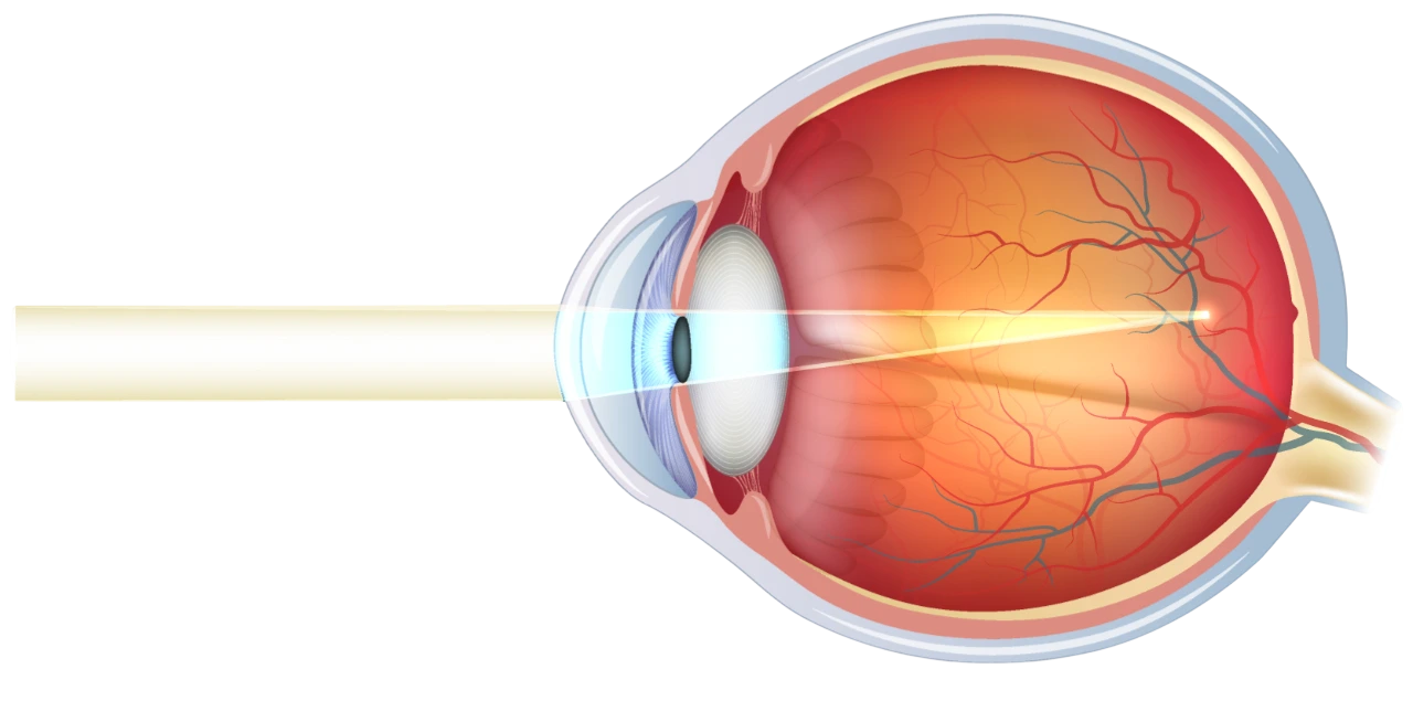La-myopie-Ophtalmologie-Paris-Est