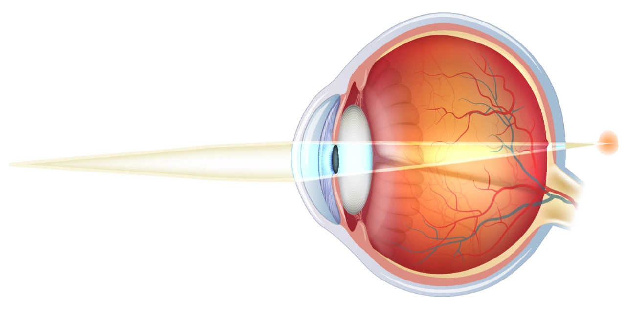 La-presbytie-Ophtalmologie-Paris-Est