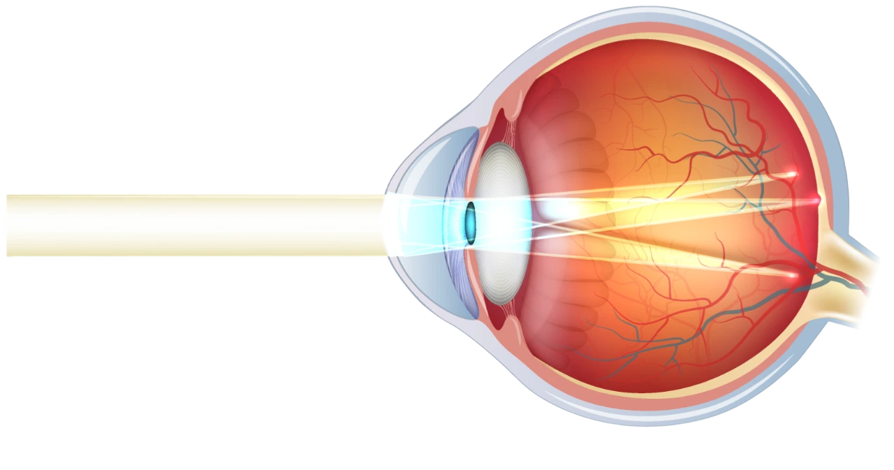 Lastigmatisme-Ophtalmologie-Paris-Est
