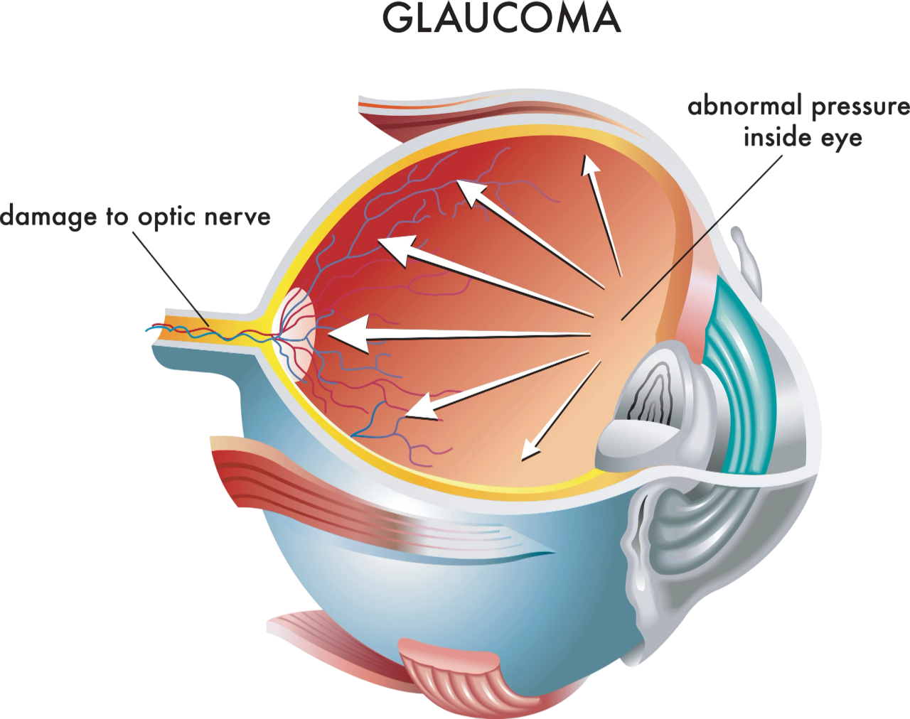 Maladies-oculaires-Glaucome-Votre ophtalmologue à St-Maur-des-Fossés & Draveil