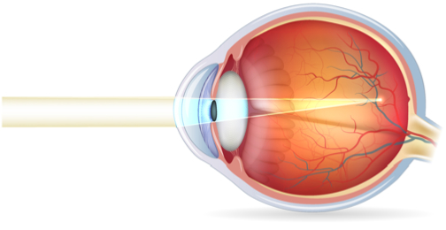 Myopie-Ophtalmologie-Paris-Est