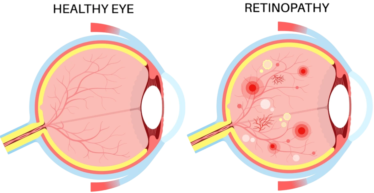 Maladies-oculaires-Glaucome-Votre ophtalmologue à St-Maur-des-Fossés & Draveil