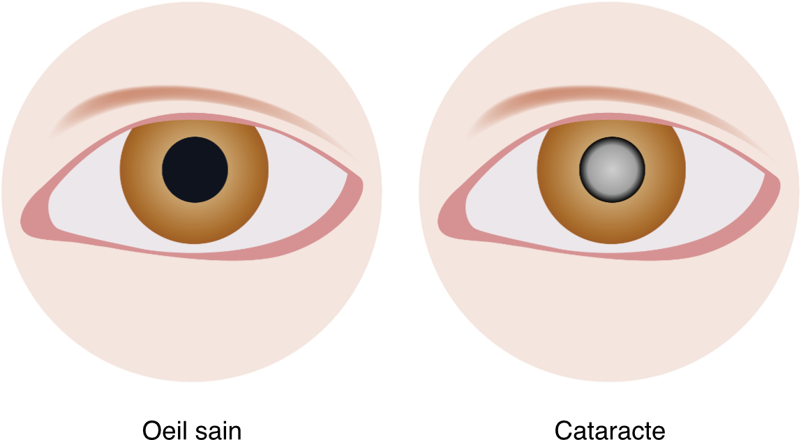 Maladies-oculaires-Glaucome-Votre ophtalmologue à St-Maur-des-Fossés & Draveil