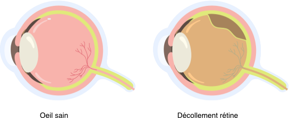 Maladies-oculaires-Glaucome-Votre ophtalmologue à St-Maur-des-Fossés & Draveil