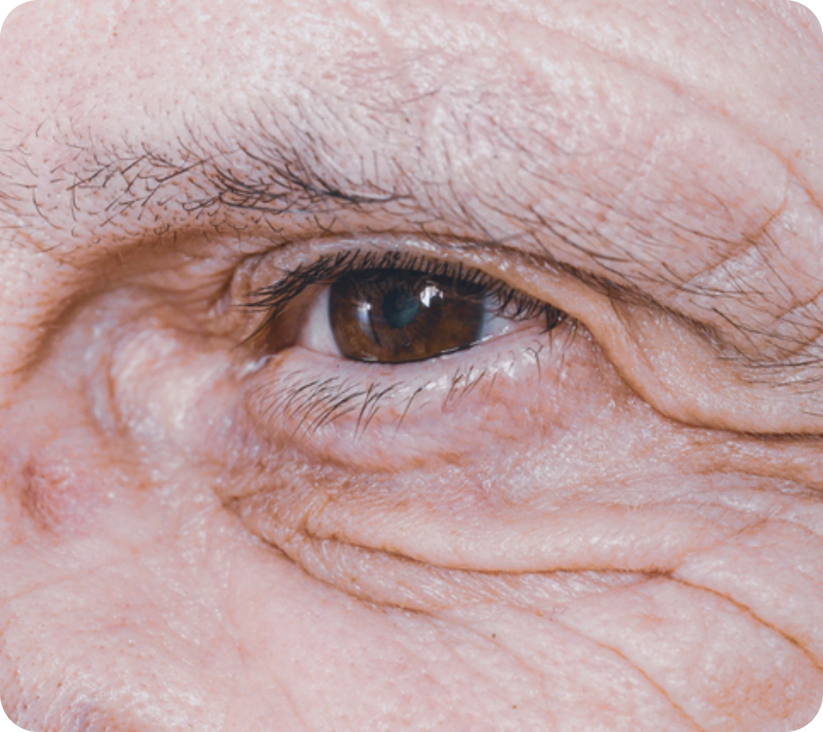 Traitement-chirurgical-Cataracte-Ophtalmo-Obernai