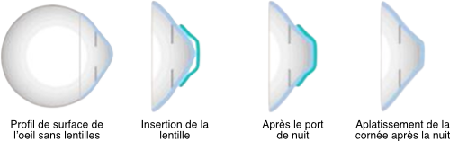 Traitement de nuit - Orthokératologie - Ophtalmo Paris Est