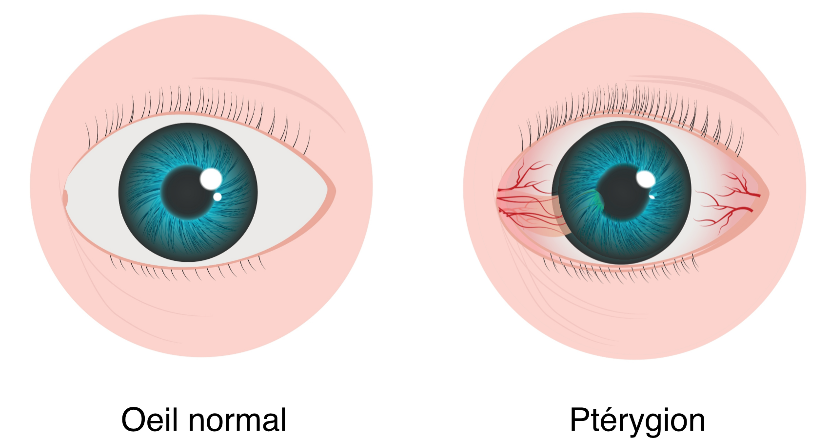 Pterygion-Votre ophtalmologue à St-Maur-des-Fossés & Draveil
