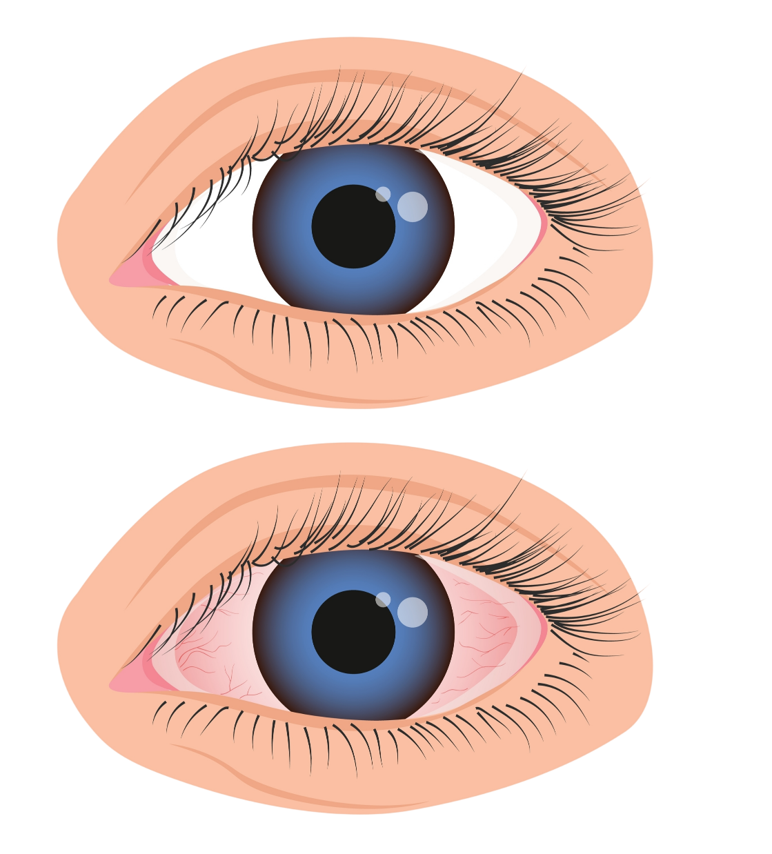 Comprendre-luveite-Uveite-Votre ophtalmologue à St-Maur-des-Fossés & Draveil