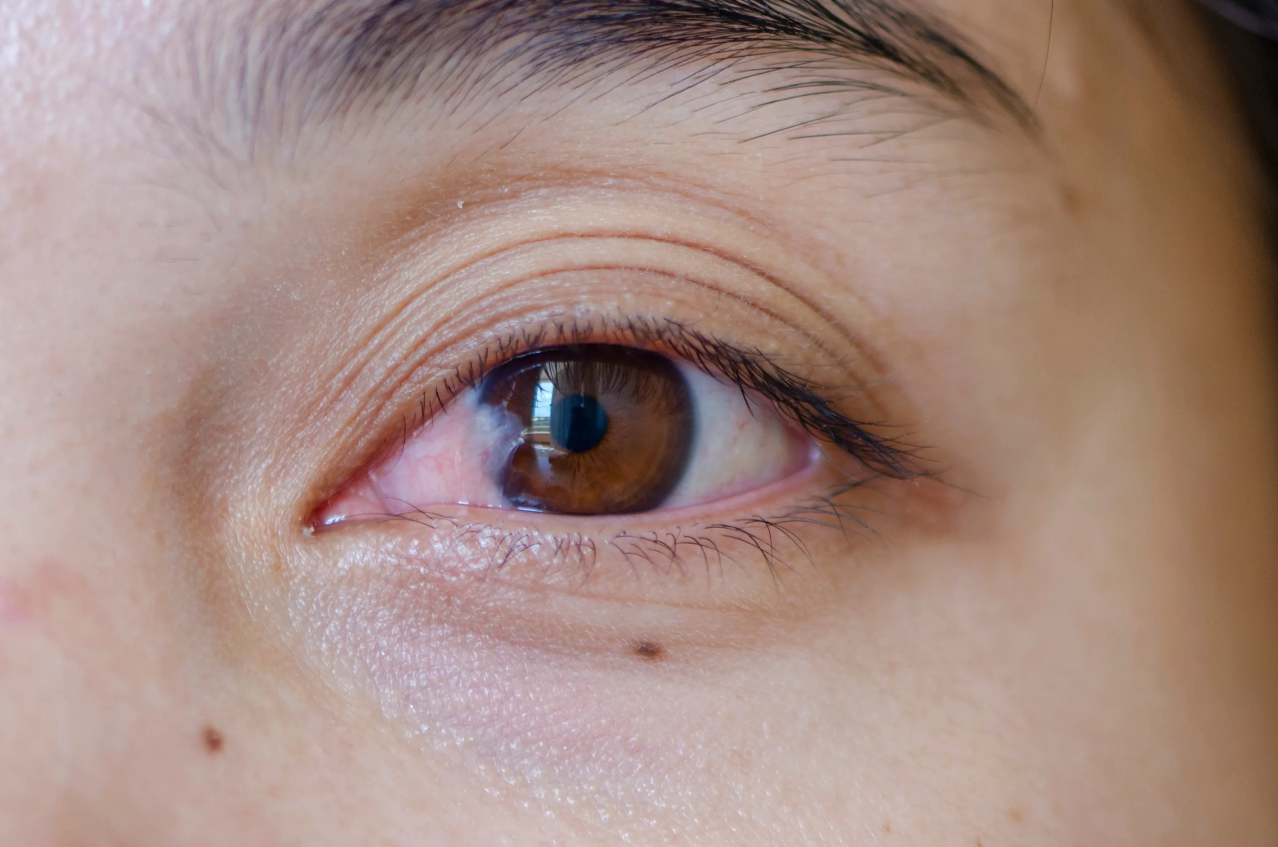 Traitement-chirurgical-Cataracte-Ophtalmo-Obernai